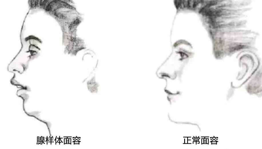 01 什么是腺樣體面容？.png